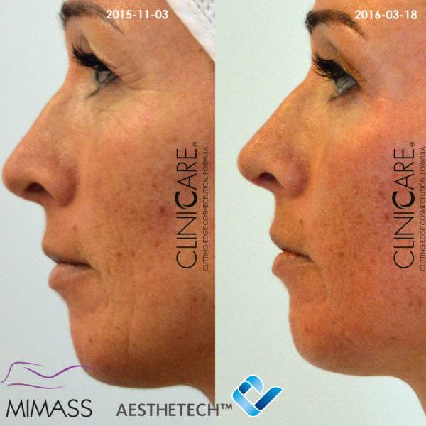 Microneedling i Helsingborg |Hudföryngring