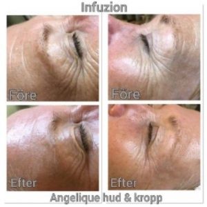 Infuzion skinbooster