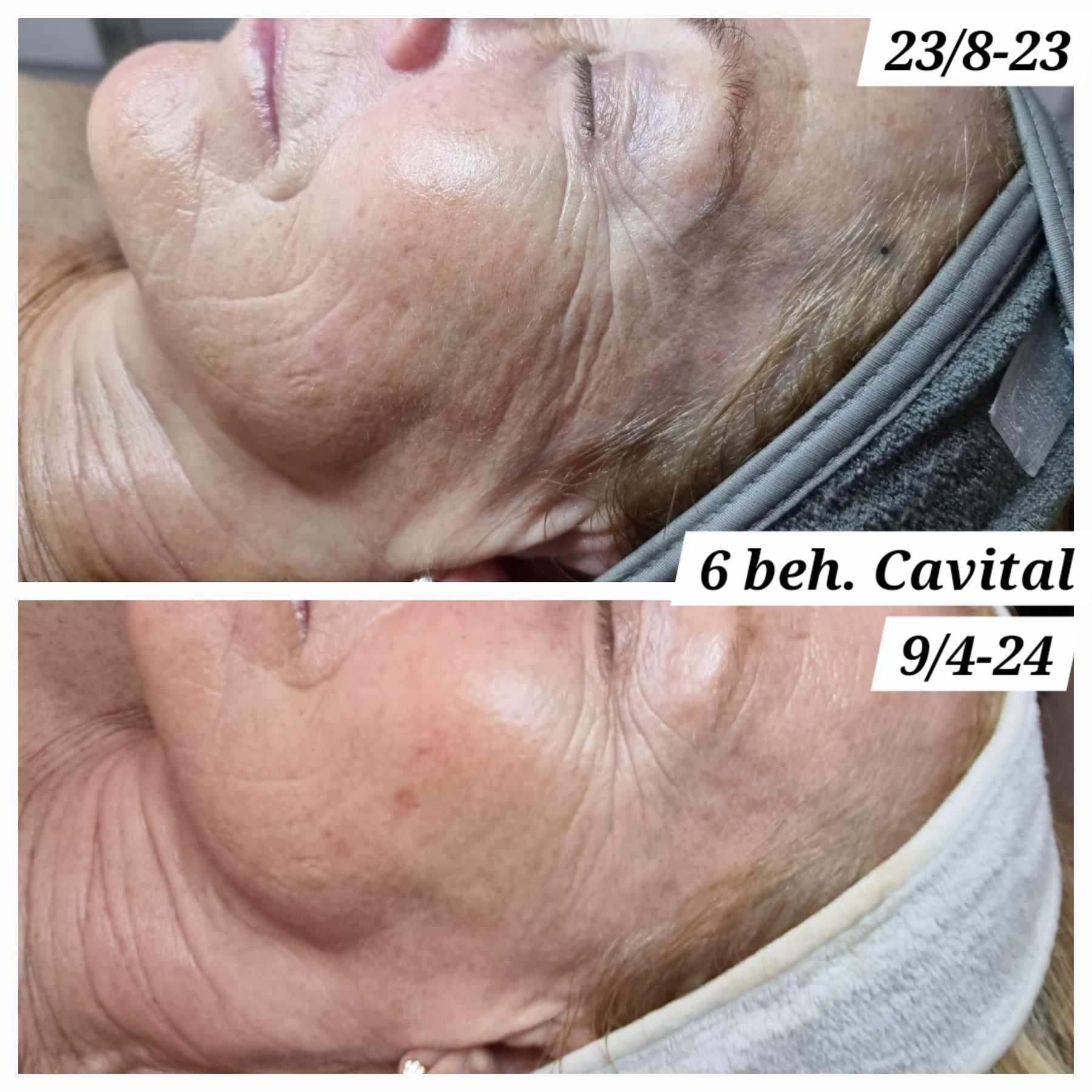 Cavital huduppstramning Skintightening