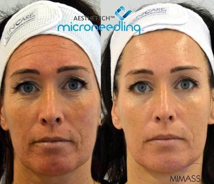 microneedling Microneedling i Helsingborg |Hudföryngring